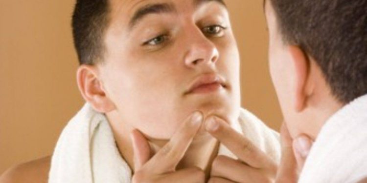 علاج آثار الحبوب والندبات بمستحضرات طبية وطبيعية