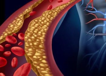 أدلة على ارتفاع الكوليسترول الضار في الدم