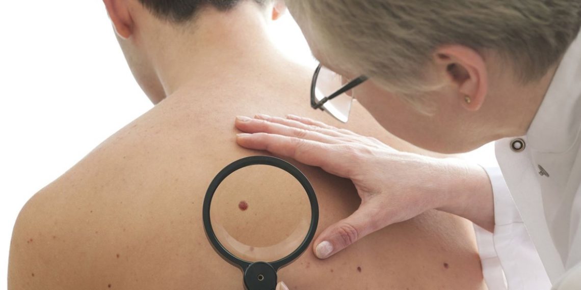 أسباب وعلاج حبوب الظهر