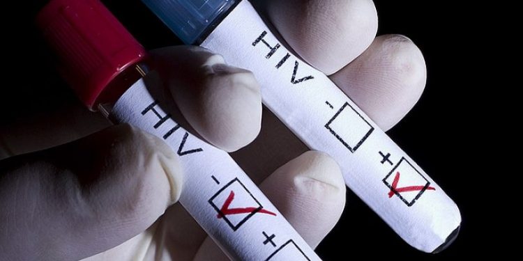 460% ارتفاع بإصابات “الإيدز” في تركيا