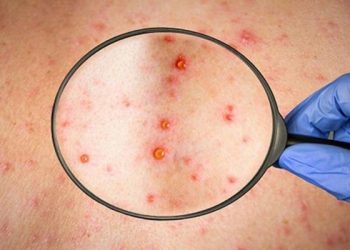 هل وصل جدري القردة إلى تركيا؟