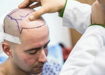 تركيا استقبلت مليون أجنبي في 2022 من أجل زراعة الشعر