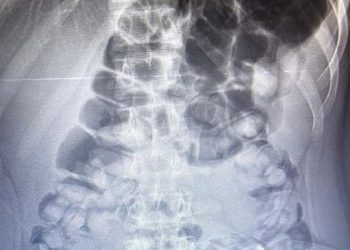 تركيا.. راكب يخفي كيلو و134 جرام أفيون في معدته!