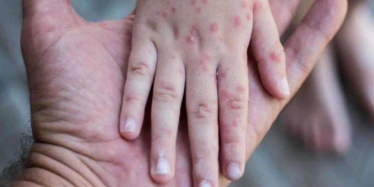 برلماني تركي: وزارة الصحة التركية تخفي إصابات الحصبة