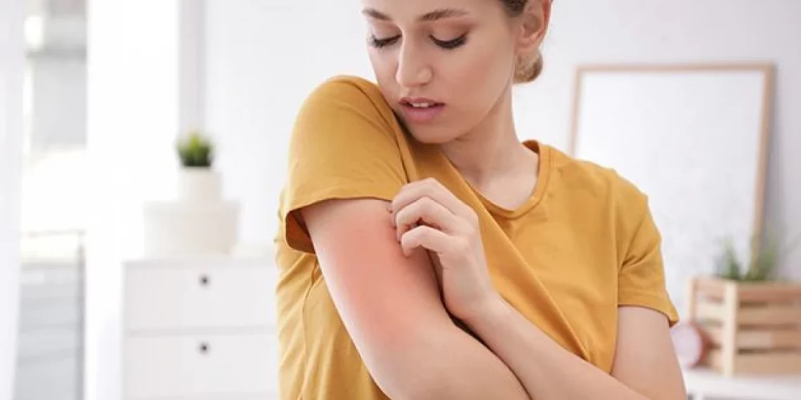 تزايد حالات الجرب في تركيا