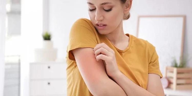 تزايد حالات الجرب في تركيا