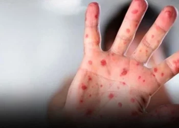 فيروس جدري الماء ينتشر بسرعة في العالم